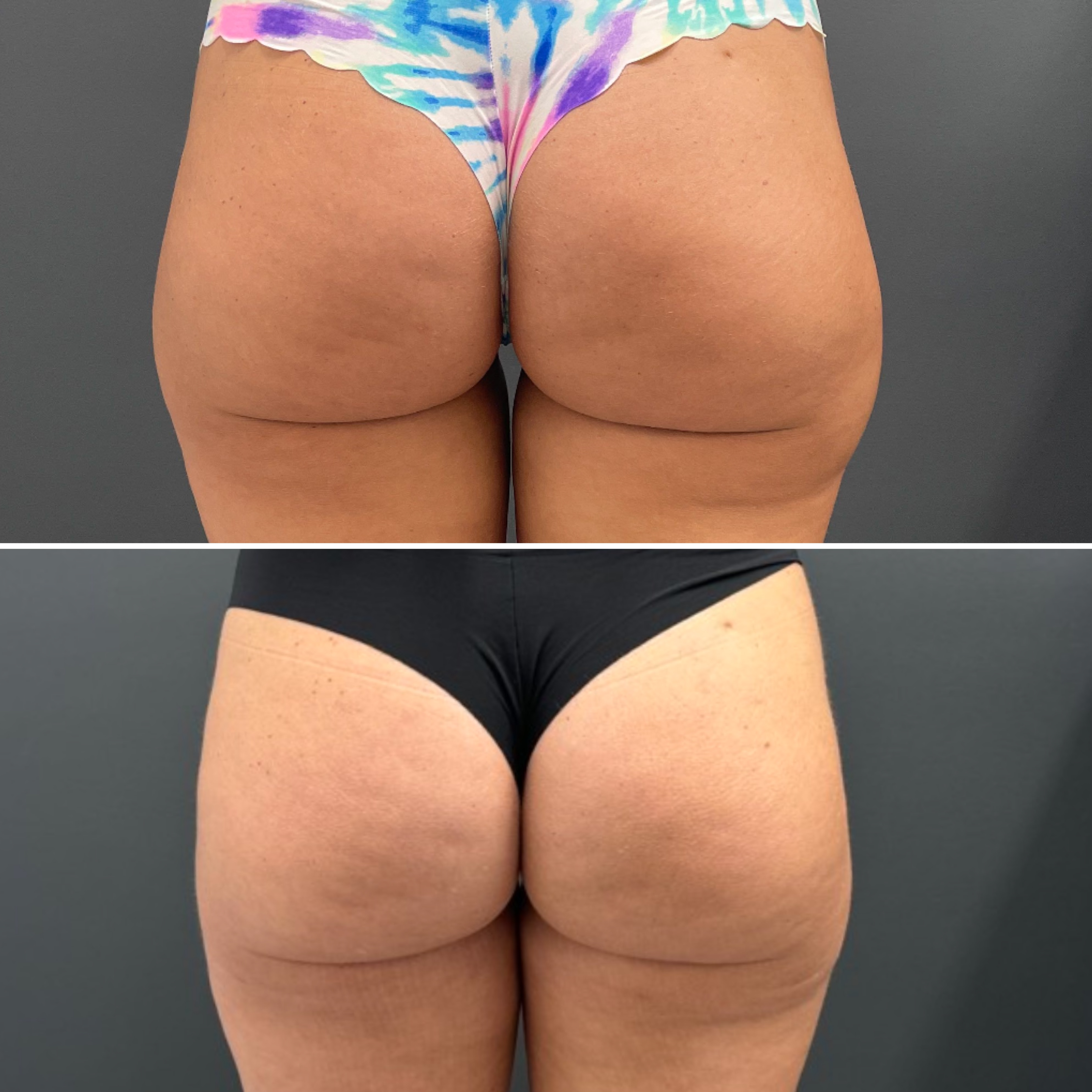 Before and after images showcasing BodyTite results on buttocks, highlighting enhanced firmness and sculpted appearance.
