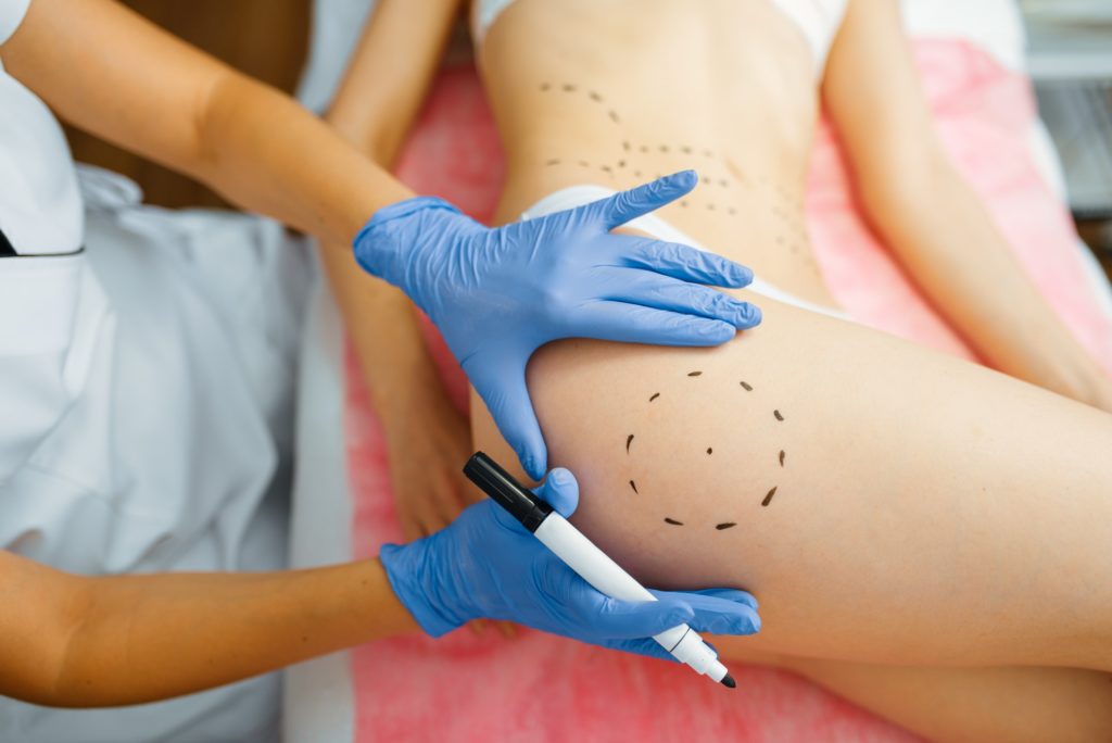Best cosmetic surgery in St. Louis - Cosmetician with marker puts dotted lines on body - a smooth, tight, and toned body shape,