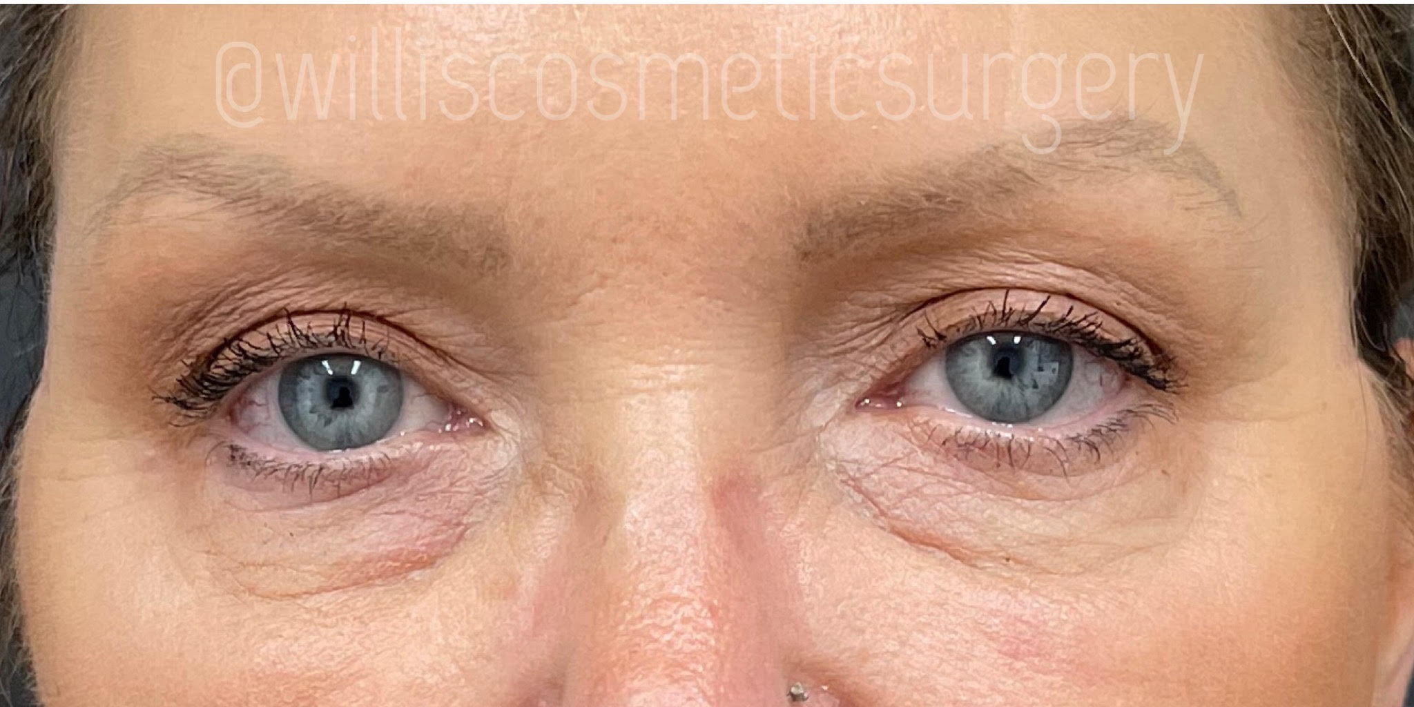 After UPPER BLEPHAROPLASTY & ACCUTITE Willis Cosmetic Surgery -St. Louis