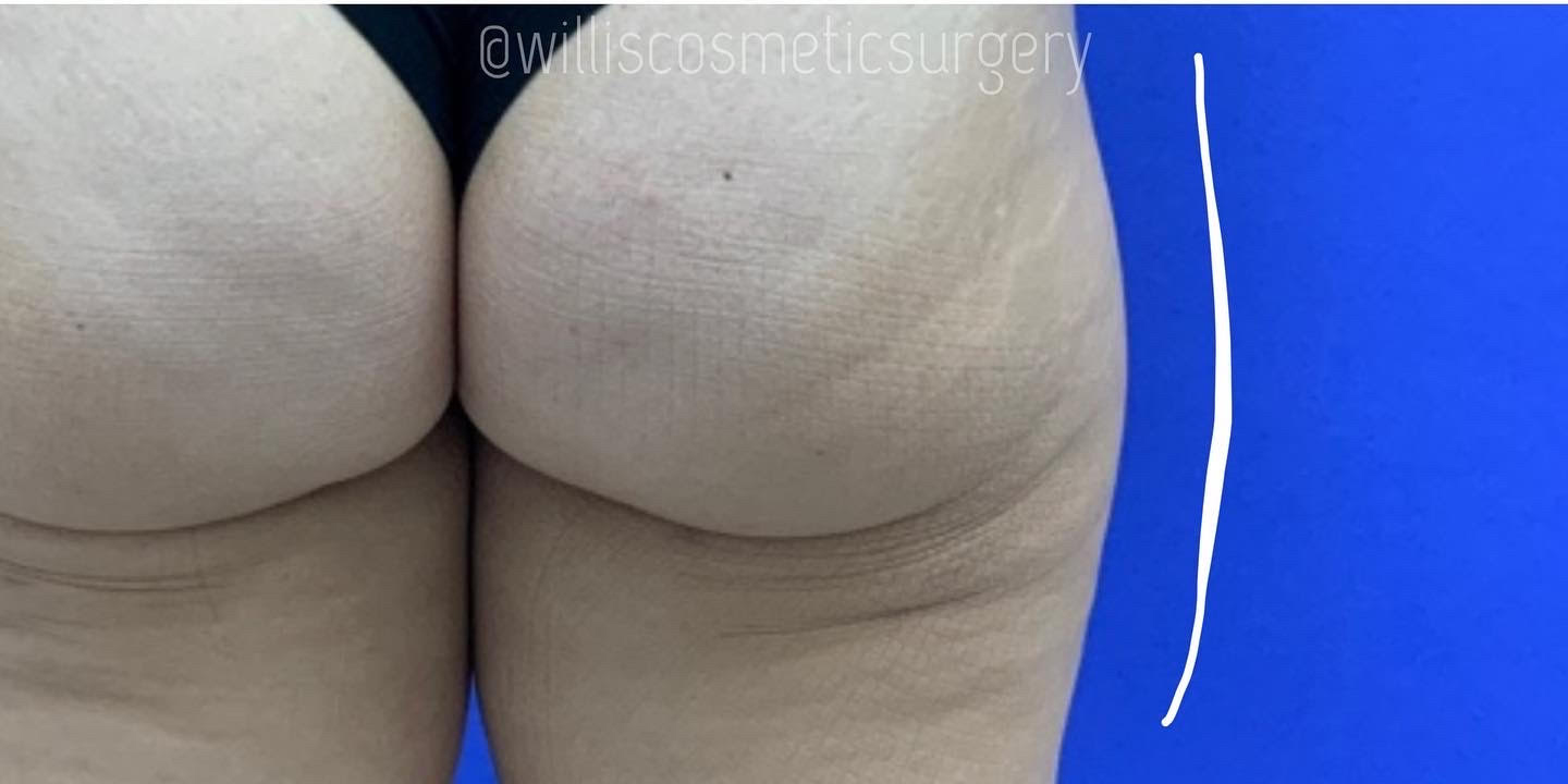 After BODYTITE - OUTER THIGHS Willis Cosmetic Surgery -St. Louis