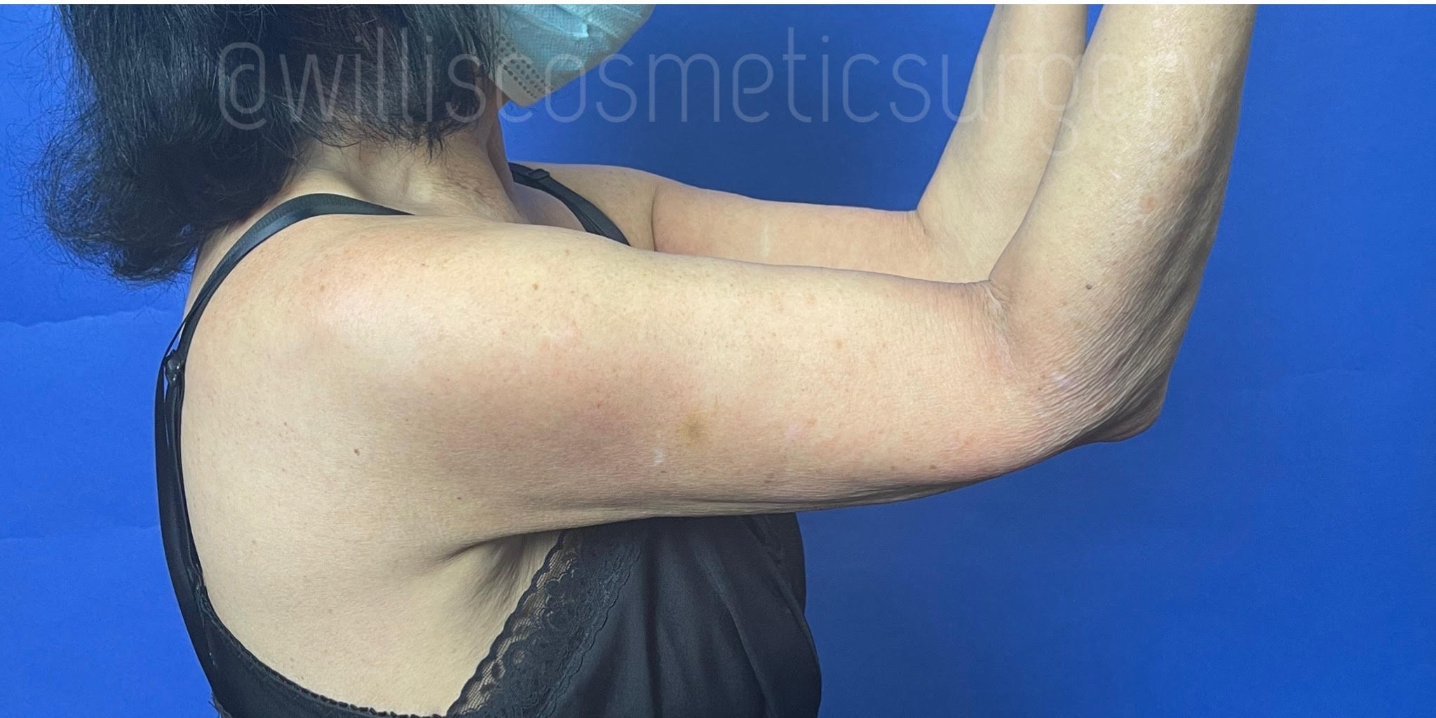 After BODYTITE - ARMS  Willis Cosmetic Surgery -St. Louis