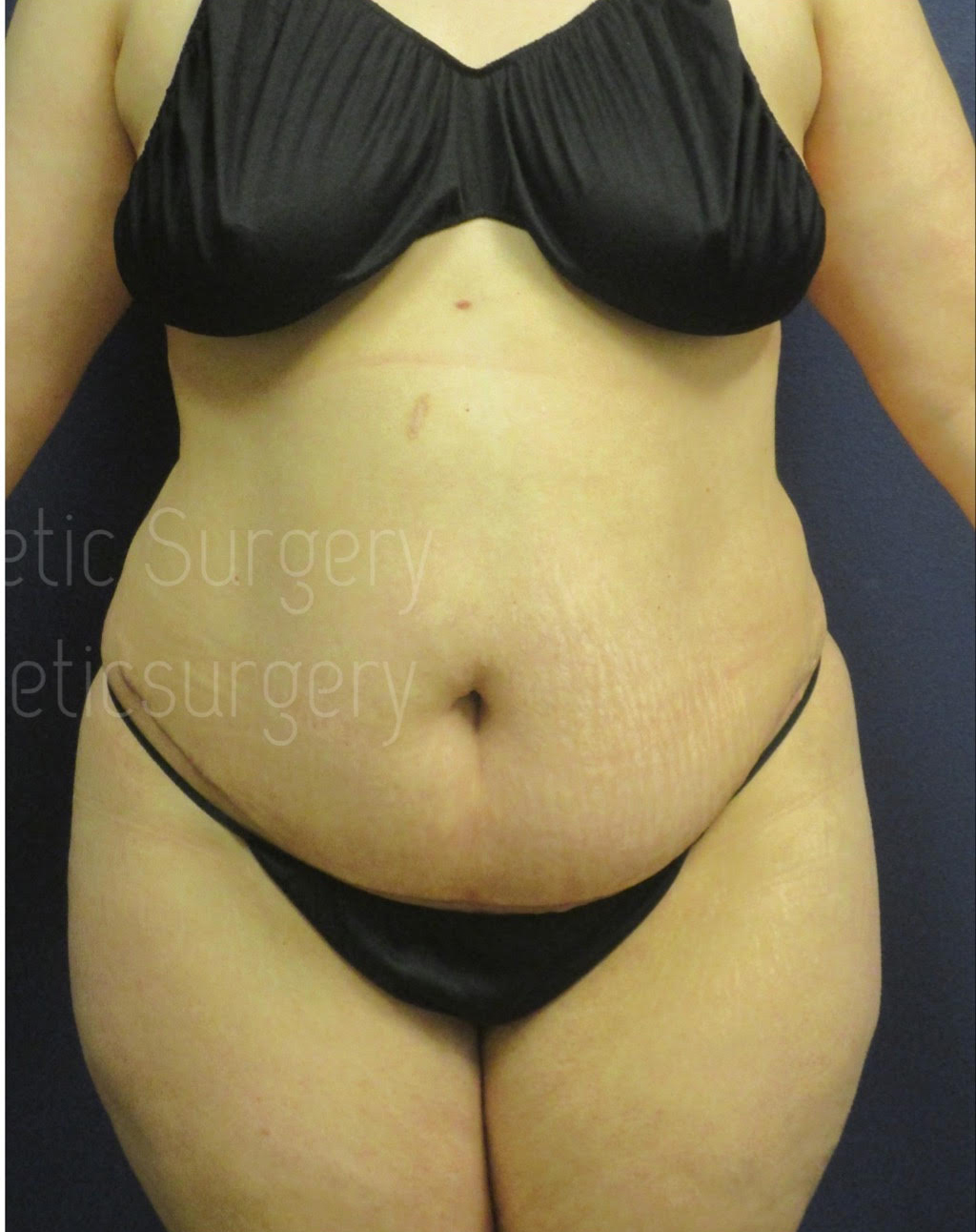 After ABDOMINAL LIPOSUCTION + MINI TUMMY TUCK Willis Cosmetic Surgery -St. Louis