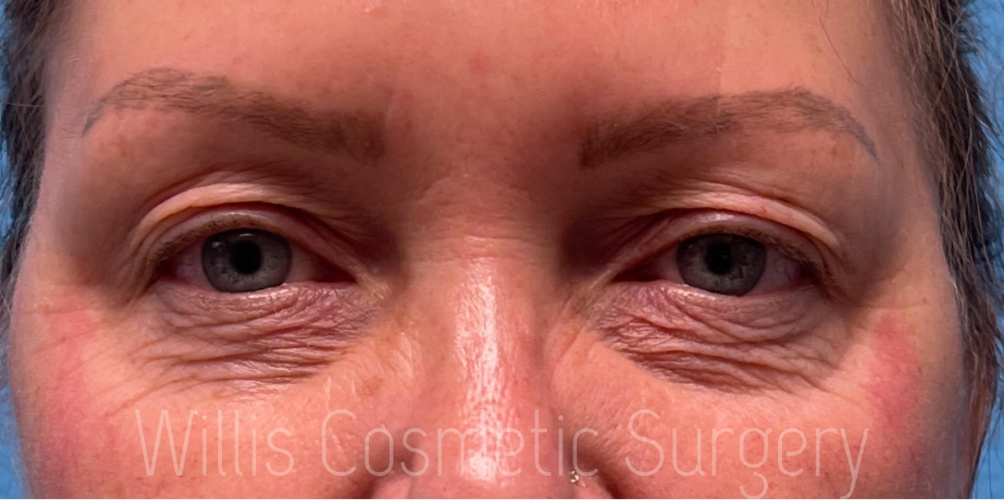 Before  UPPER BLEPHAROPLASTY & ACCUTITE Willis Cosmetic Surgery -St. Louis