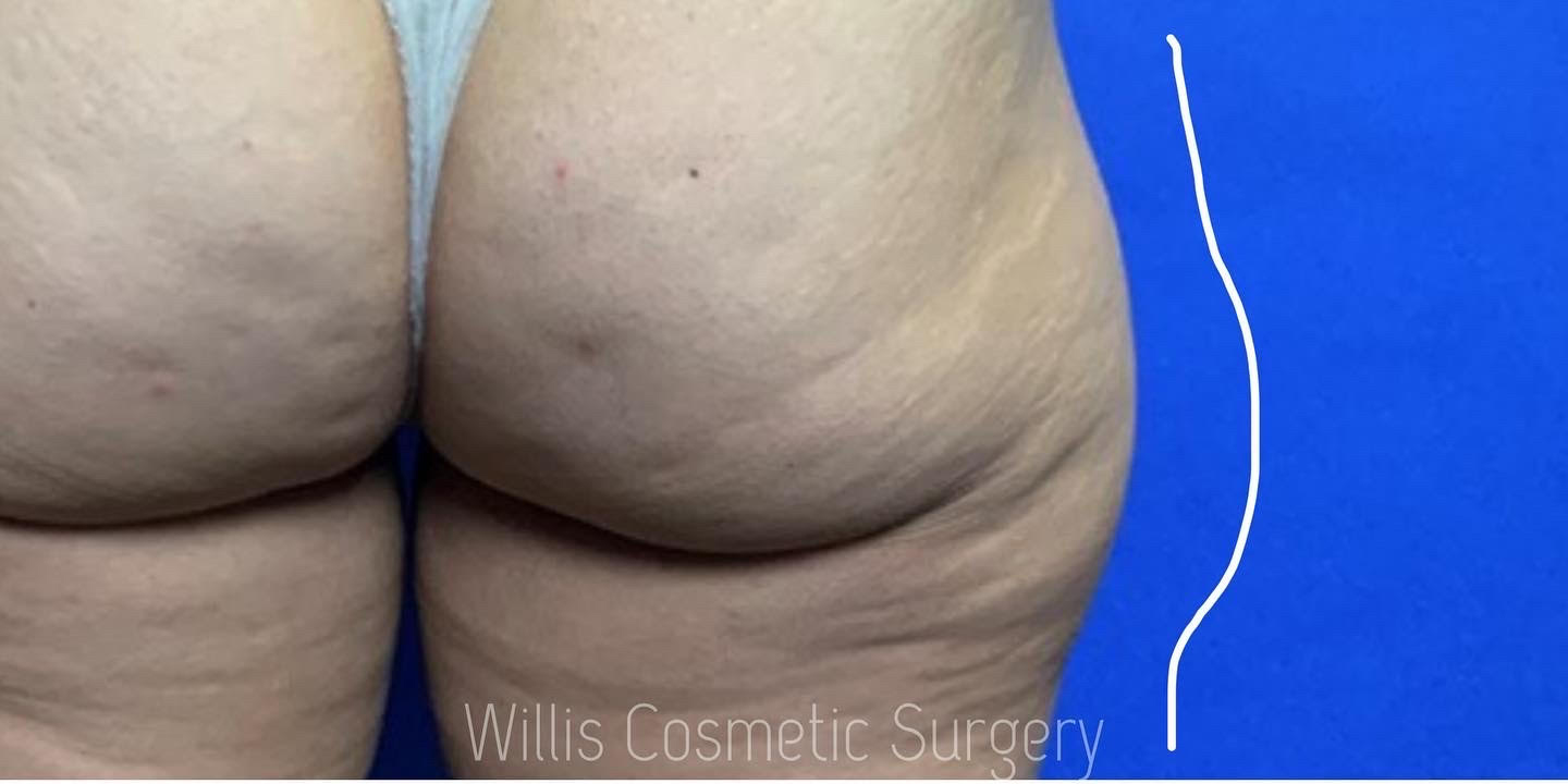 Before BODYTITE - OUTER THIGHS Willis Cosmetic Surgery -St. Louis