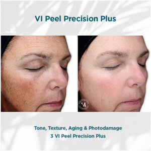 VI Peel Precision Plusin St. Louis, MO best cosmetic surgery and med spa products