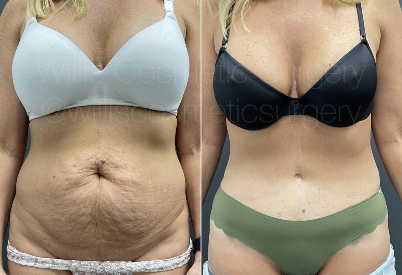 Traditional tummy tuck Abdominoplasty (Tummy Tuck)