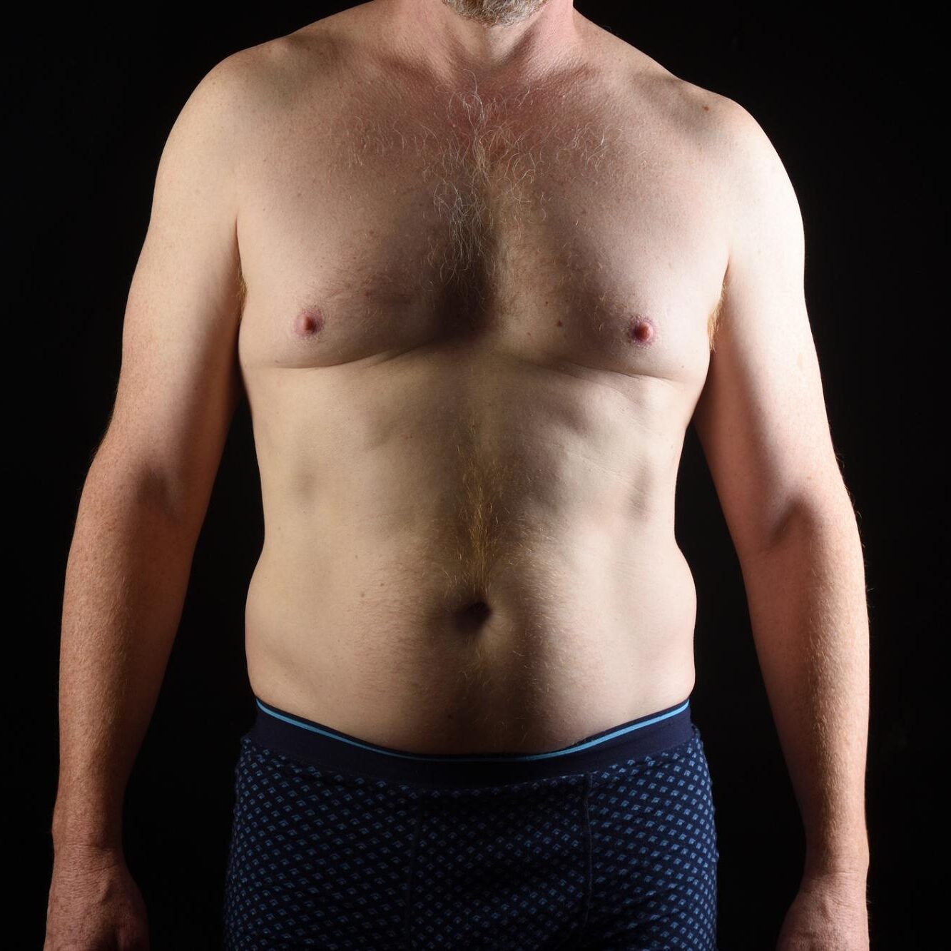 Male Chest Reduction